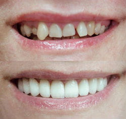 Фото до и после реставрации кривых зубов