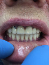 Установка съемных протезов на зубы: фото после