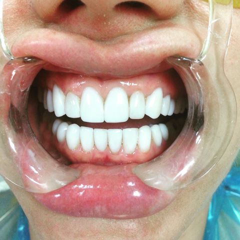 Фото восстановленных передних зубов