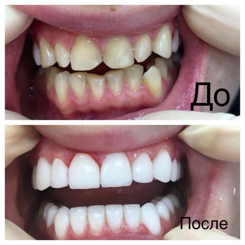Фото до и после эстетической реставрации зубов