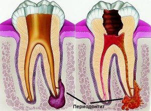 Признаки периодонтита зуба