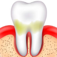 Гингивит на пораженном зубе