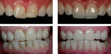 Реставрация кривого зуба: фото до и после