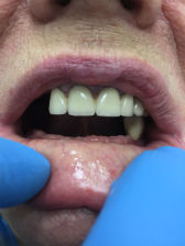 Установка съемных протезов на зубы: фото до
