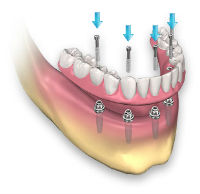 Съемный зубной протез на имплантах