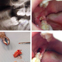Фото этапов операции по удалению зуба мудрости